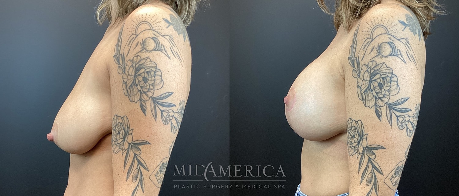 Breast Augmentation & Lift Before & After