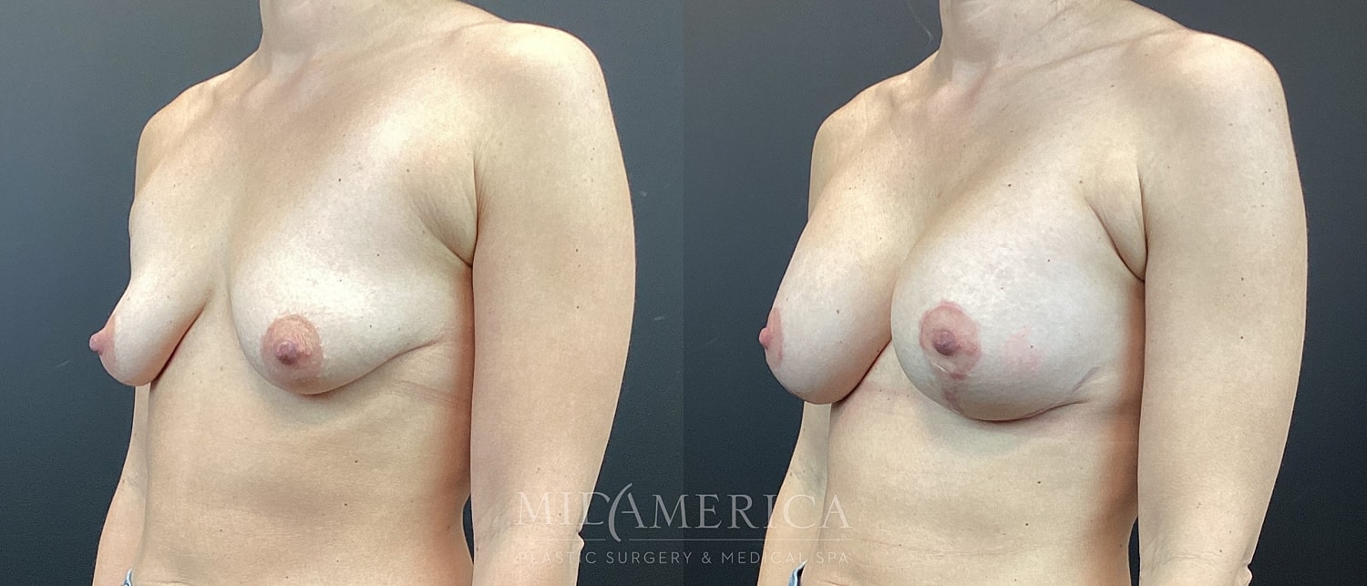 Breast enhancement before and after images.
