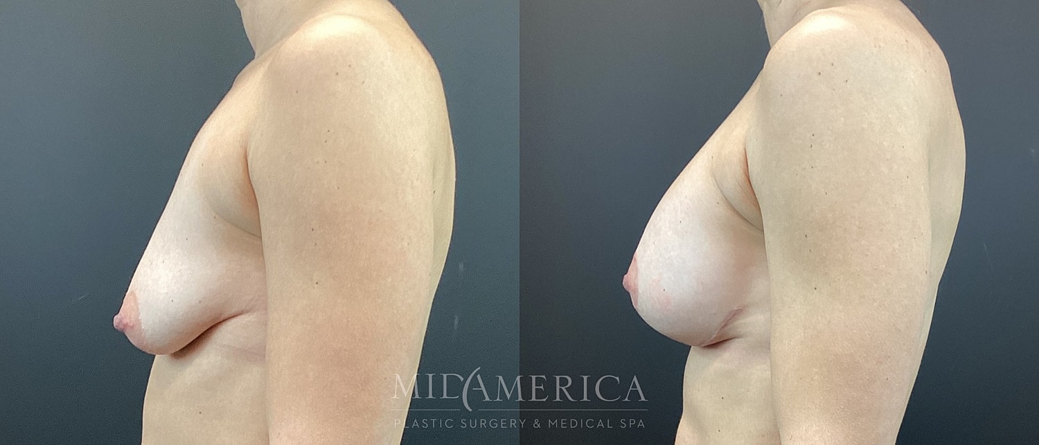 Side profile of breast enhancement before and after.