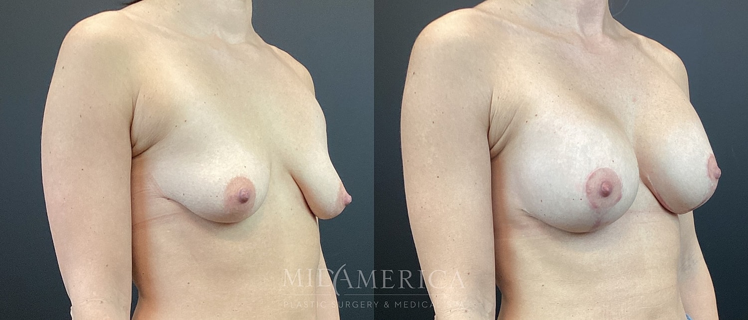 Before and after breast augmentation photos.