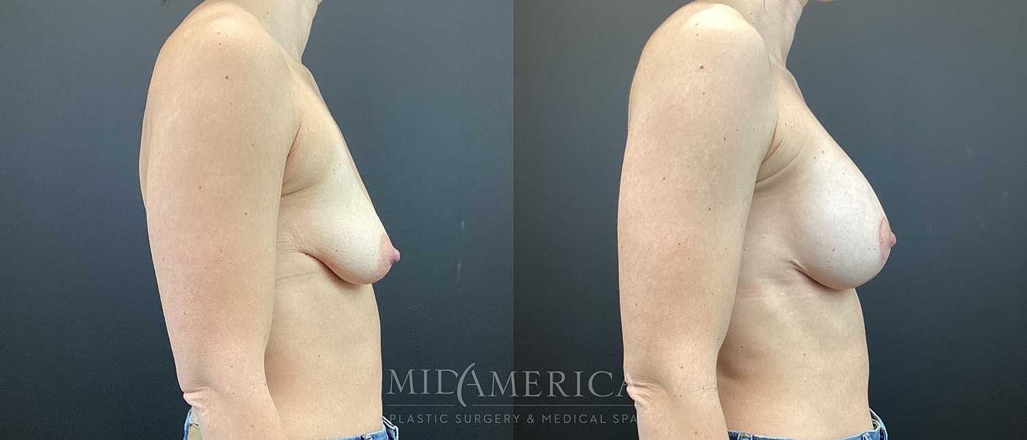 Before and after breast augmentation side view