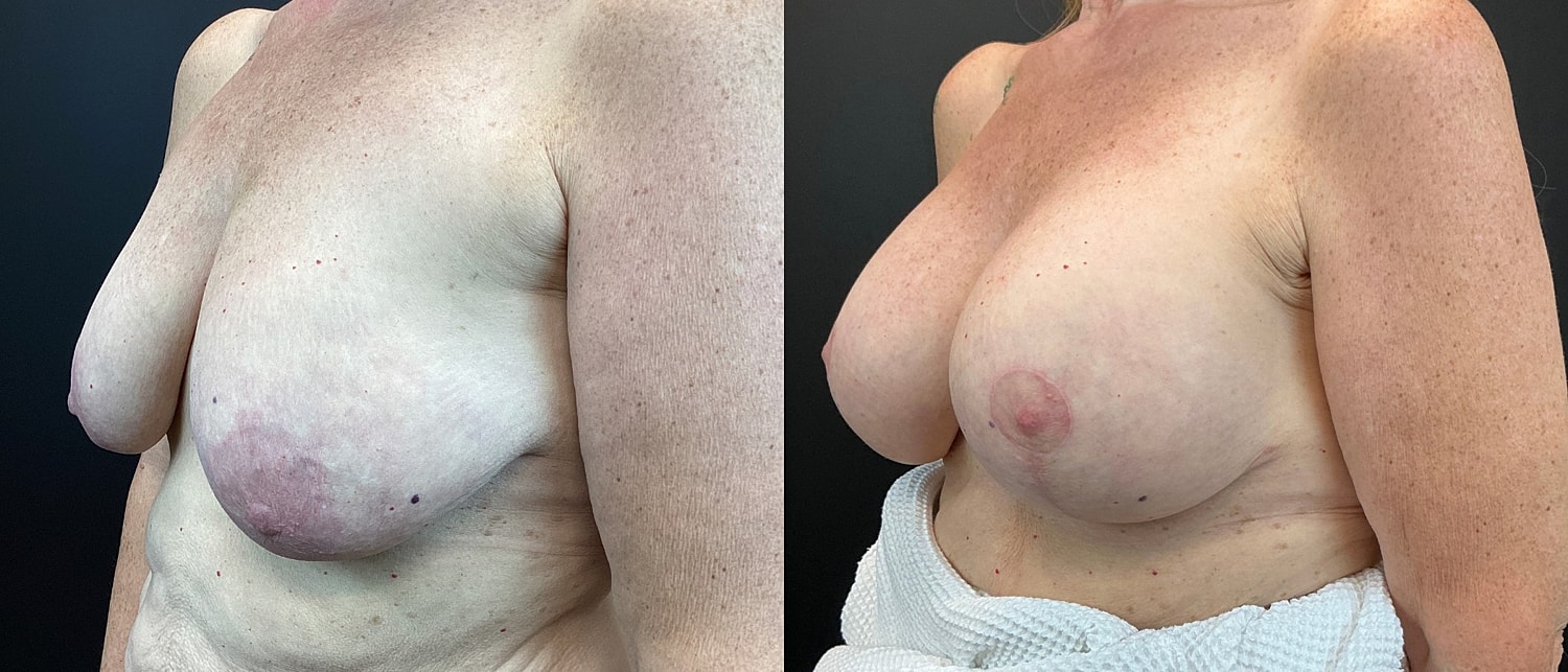 Breast Augmentation & Lift Before & After