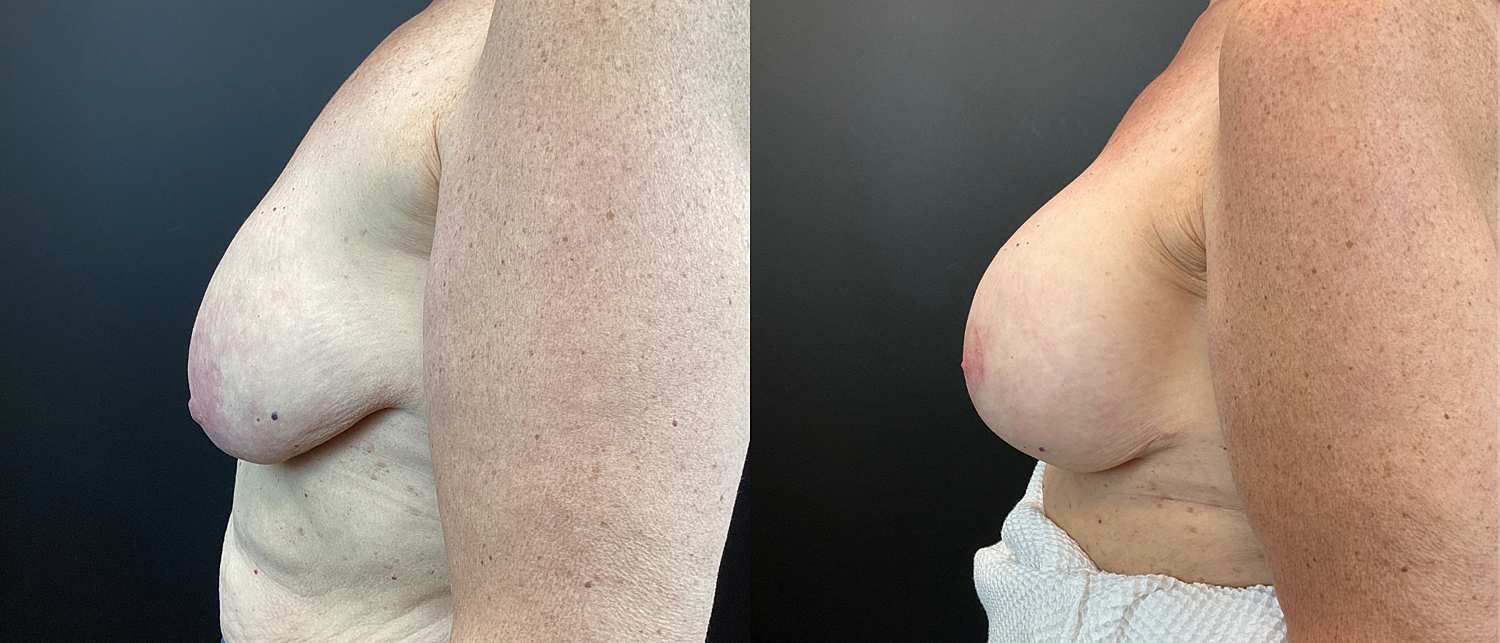 Breast Augmentation & Lift Before & After