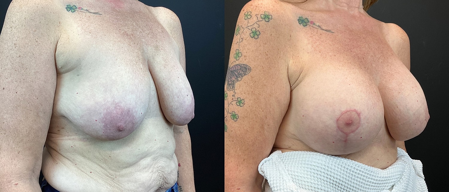 Breast Augmentation & Lift Before & After