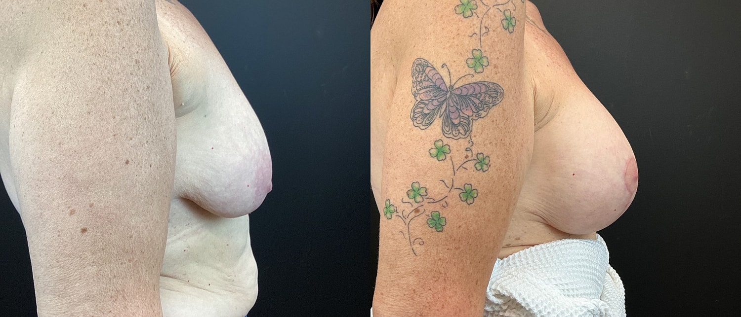 Breast Augmentation & Lift Before & After