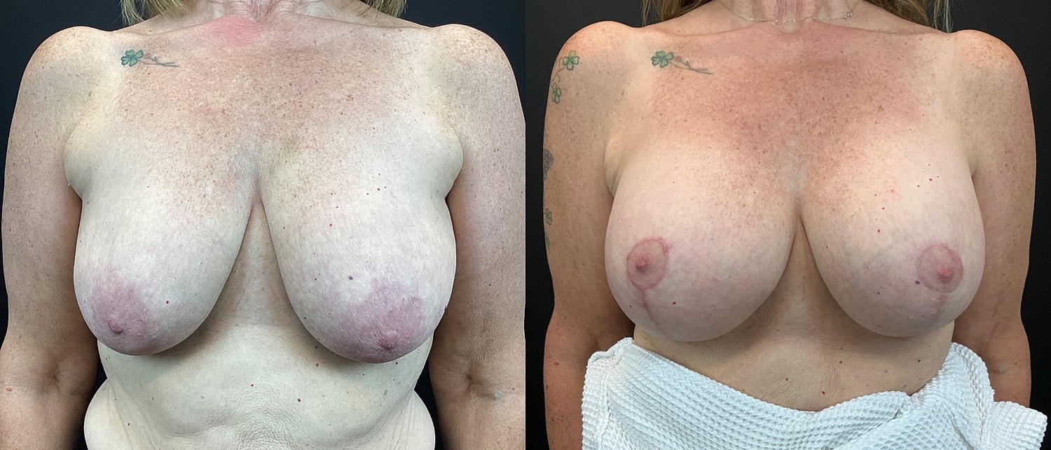 Breast Augmentation & Lift Before & After