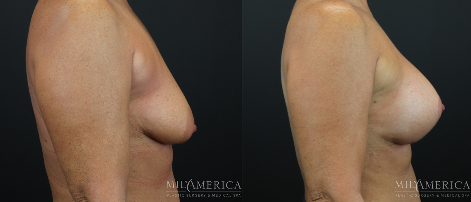 Breast Augmentation & Lift Before & After