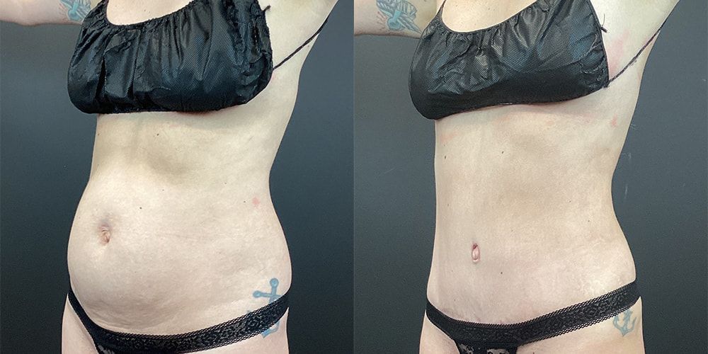 Tummy Tuck Before & After