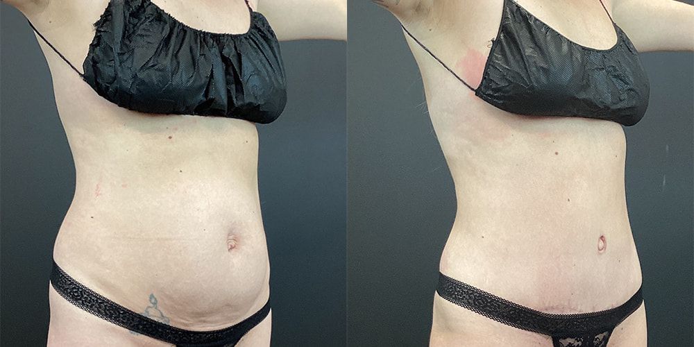Tummy Tuck Before & After
