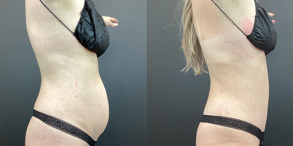 Tummy Tuck Before & After