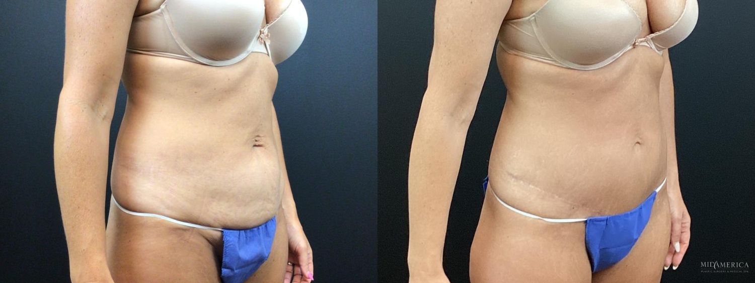 Tummy Tuck Before & After