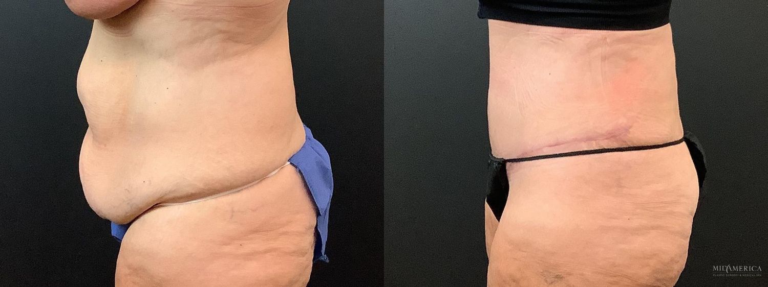 Tummy Tuck Before & After