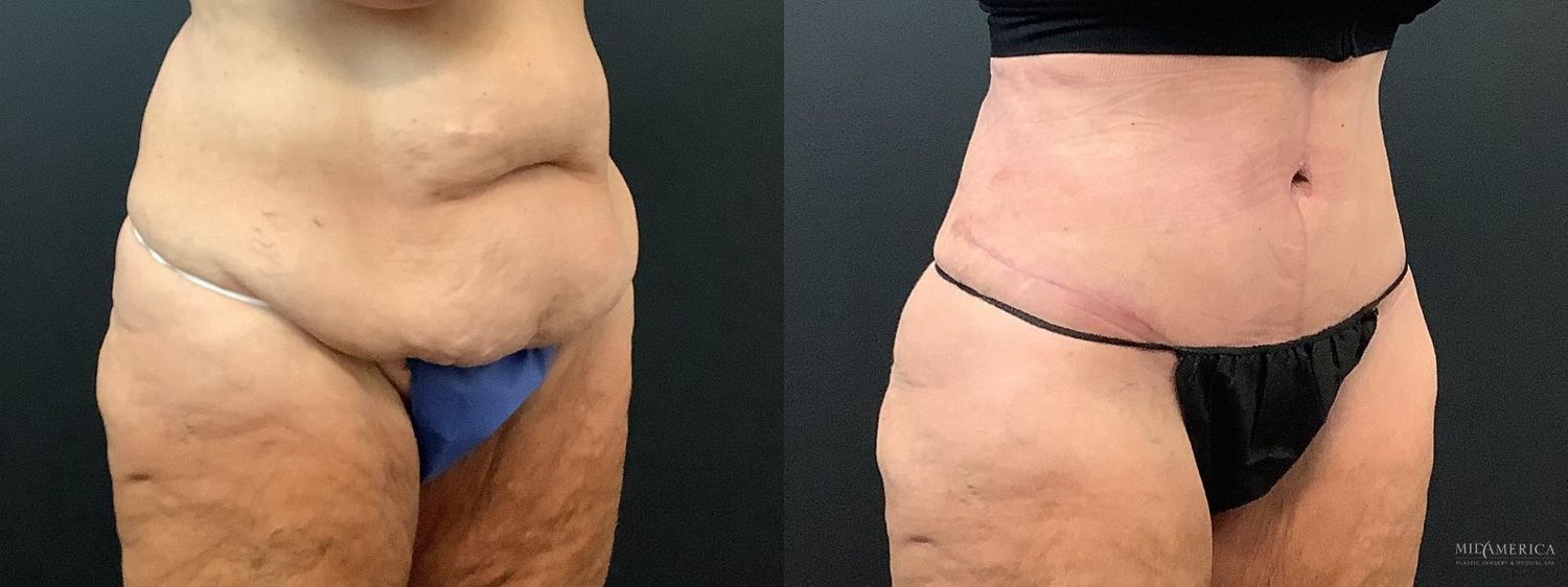 Tummy Tuck Before & After