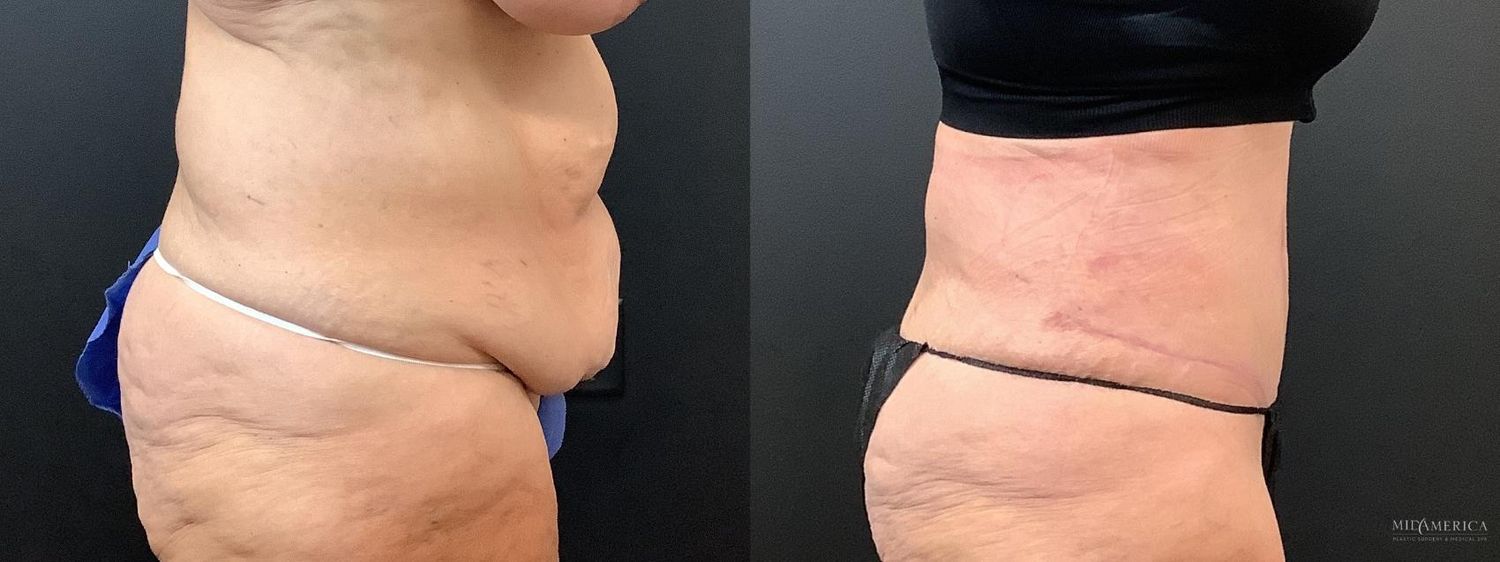 Tummy Tuck Before & After