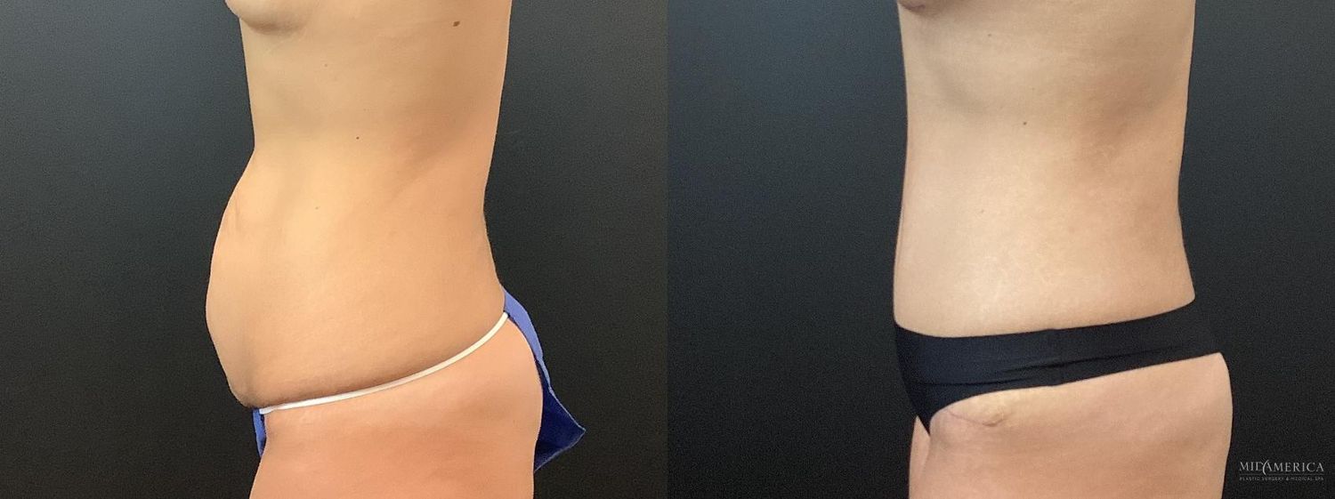 Tummy Tuck Before & After