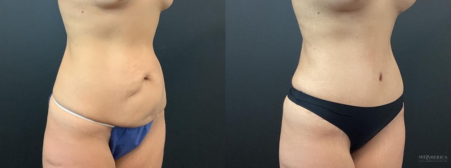 Tummy Tuck Before & After