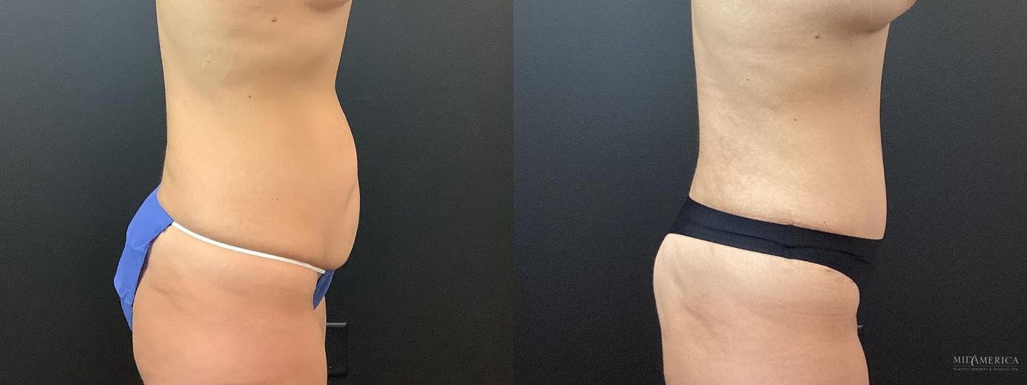 Tummy Tuck Before & After