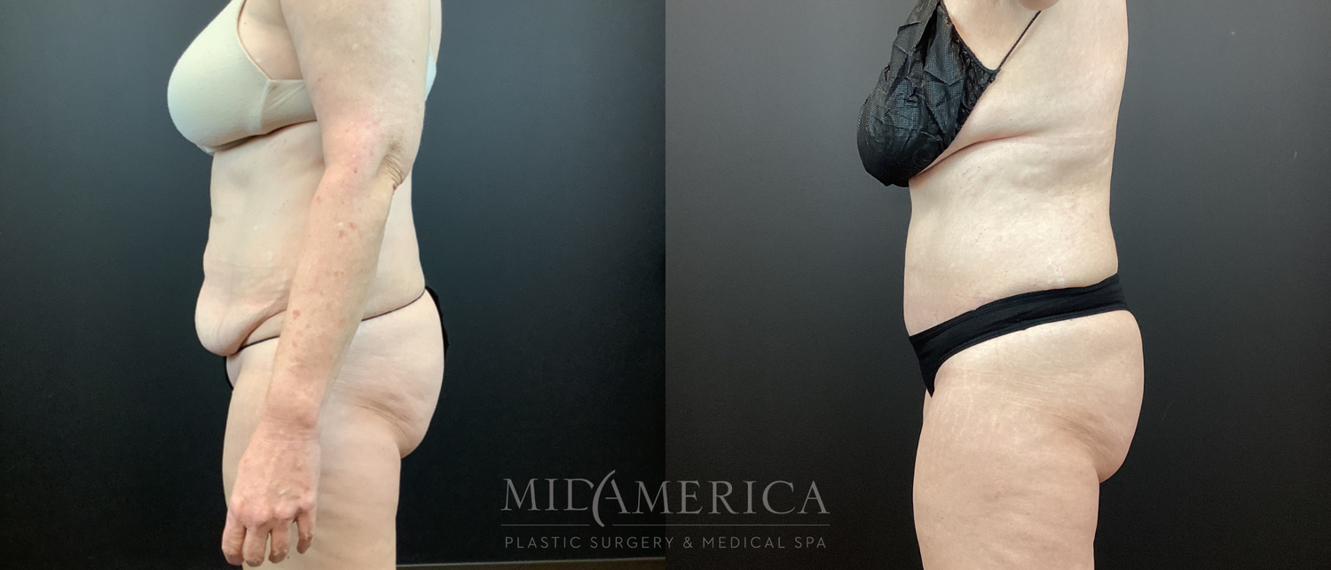 Tummy Tuck Before & After