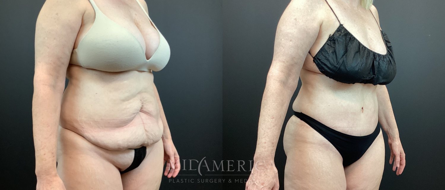 Tummy Tuck Before & After