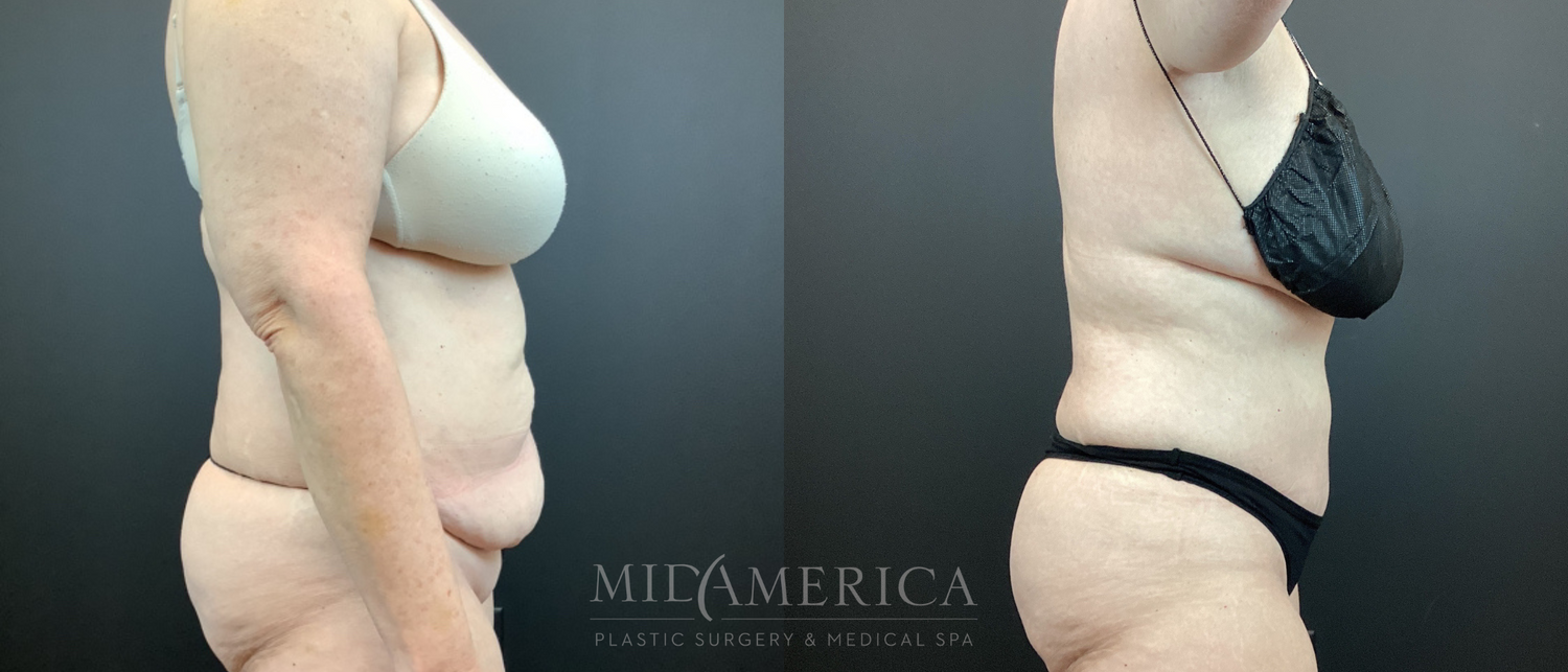 Tummy Tuck Before & After