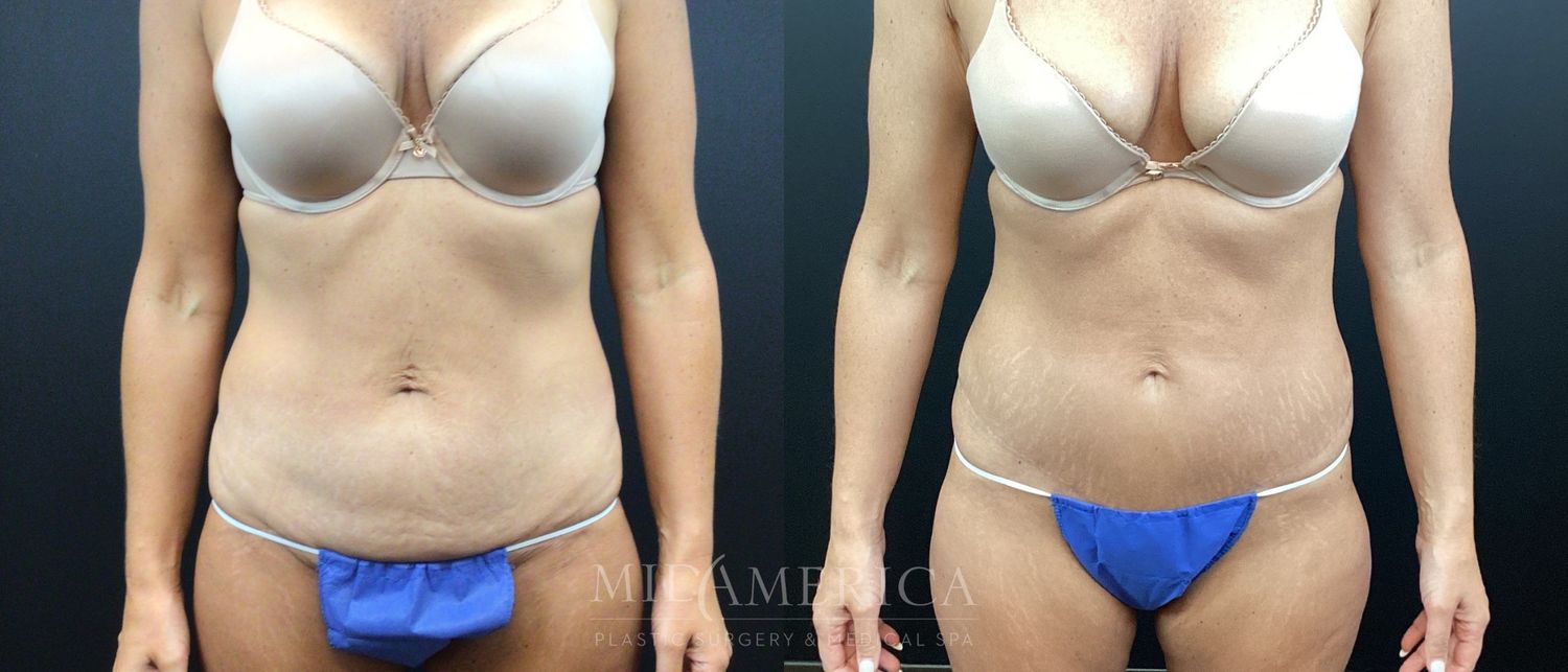 Tummy Tuck Before & After