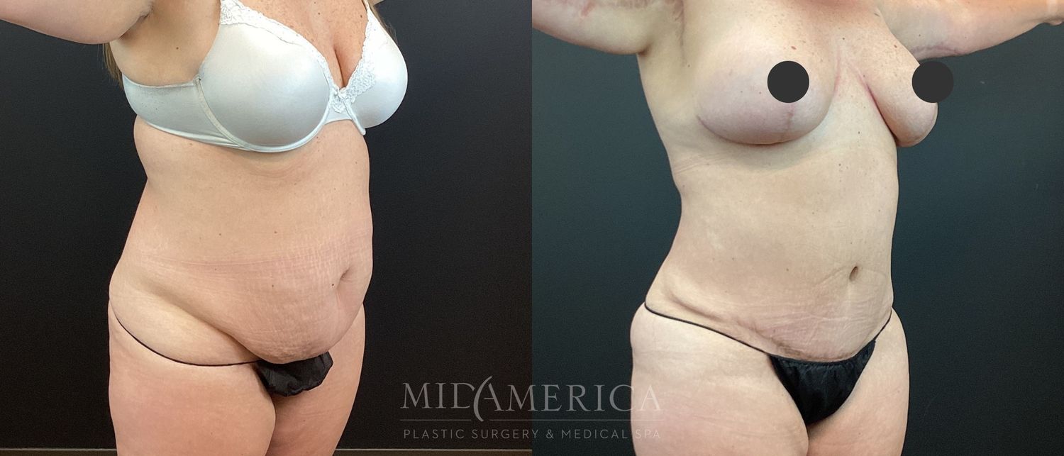 Tummy Tuck Before & After