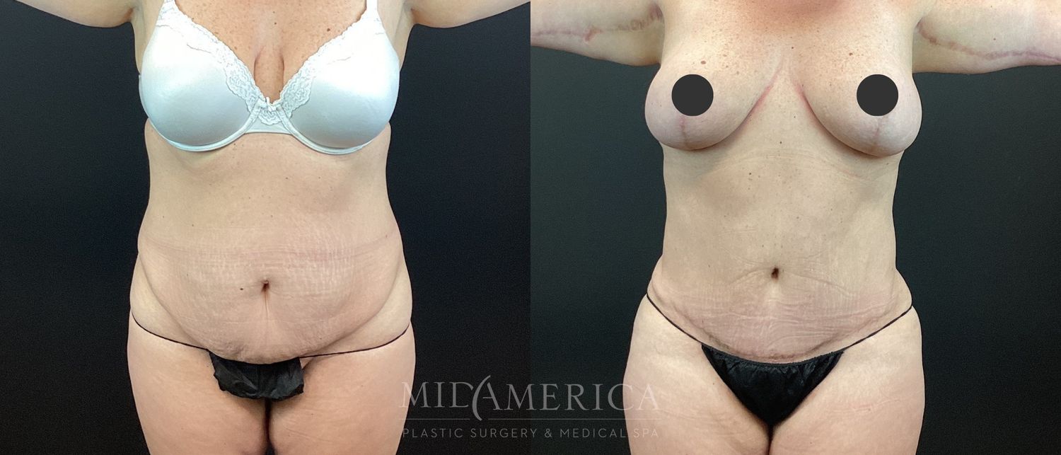 Tummy Tuck Before & After