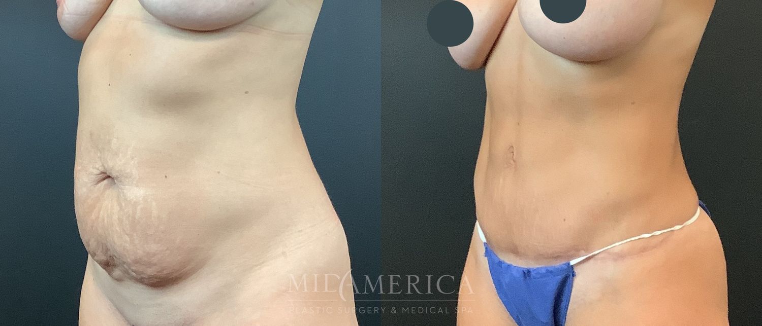 Tummy Tuck Before & After