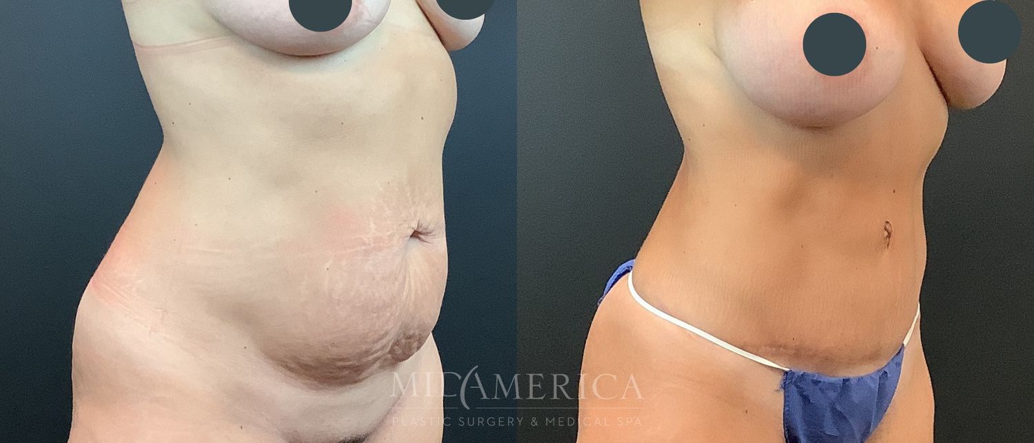 Tummy Tuck Before & After