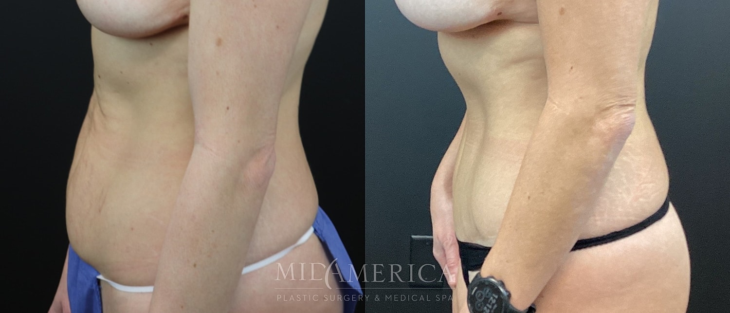 Before and after body contouring surgery comparison.