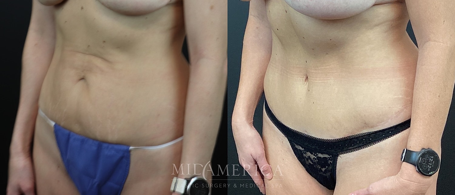 Before and after body contouring results.