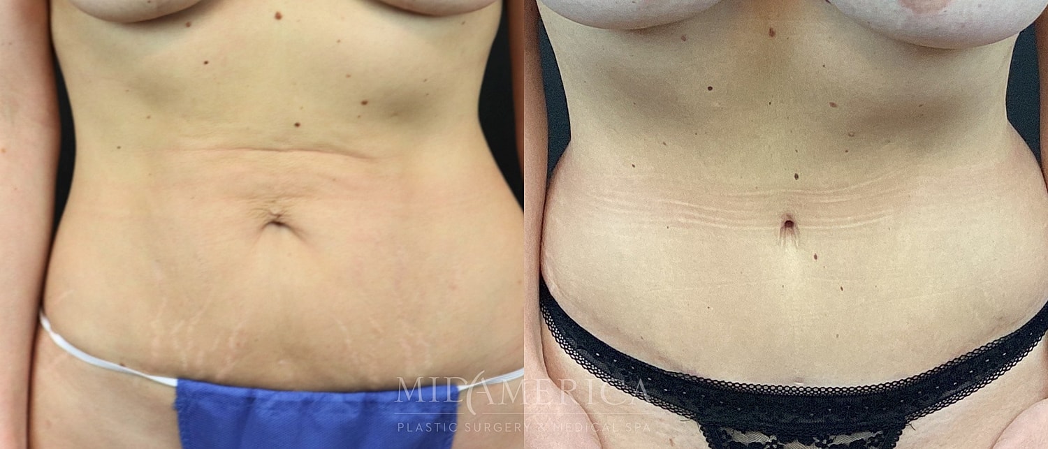 Before and after body image transformation.