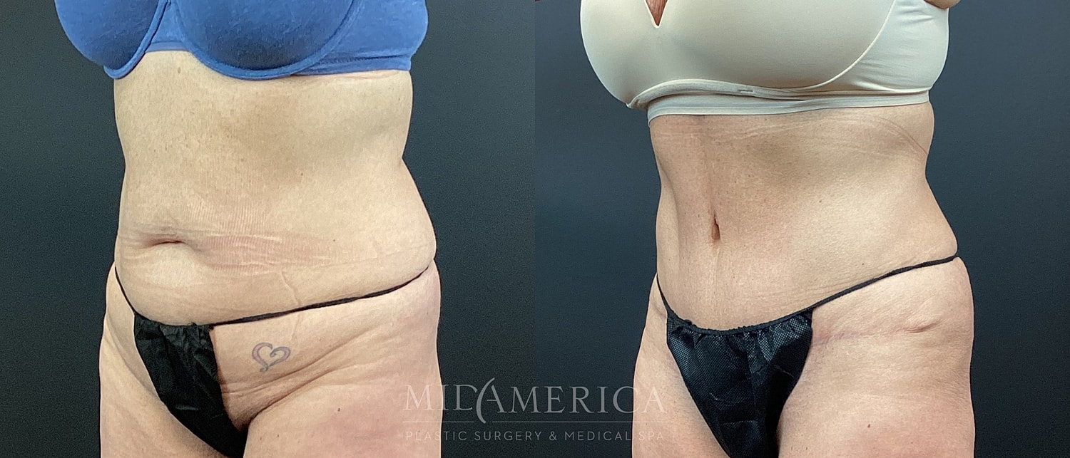 Tummy Tuck Before & After