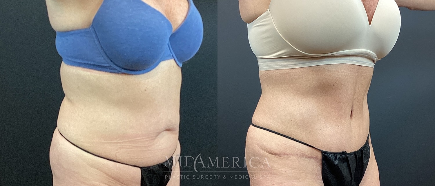 Tummy Tuck Before & After