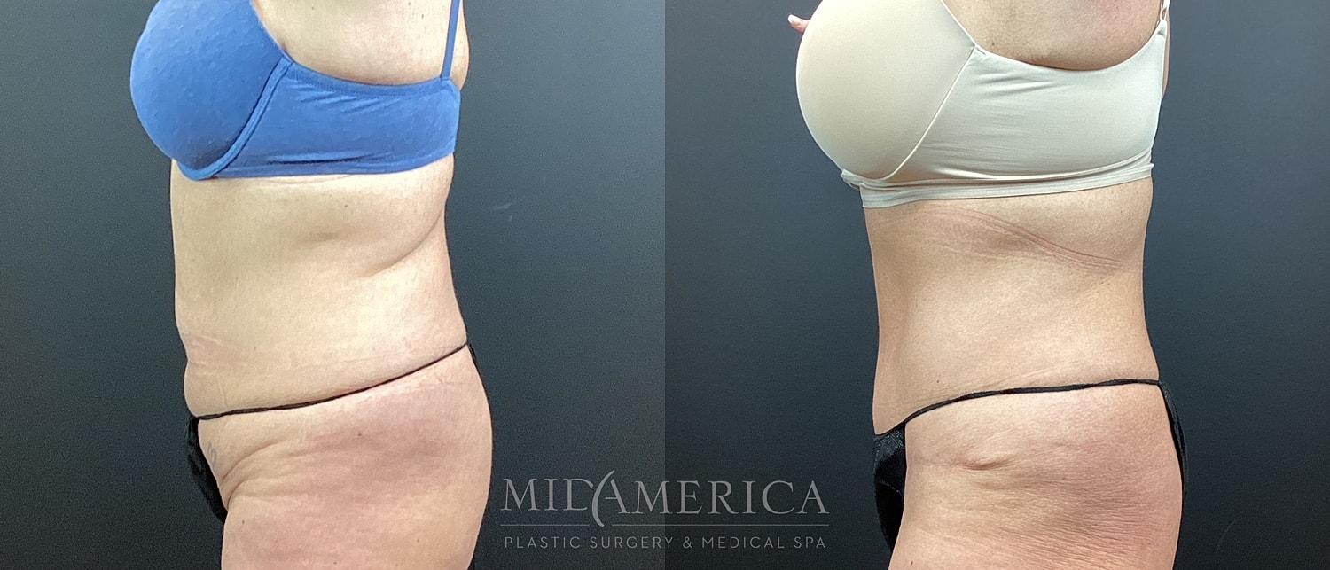 Tummy Tuck Before & After