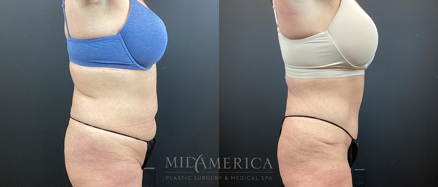 Tummy Tuck Before & After
