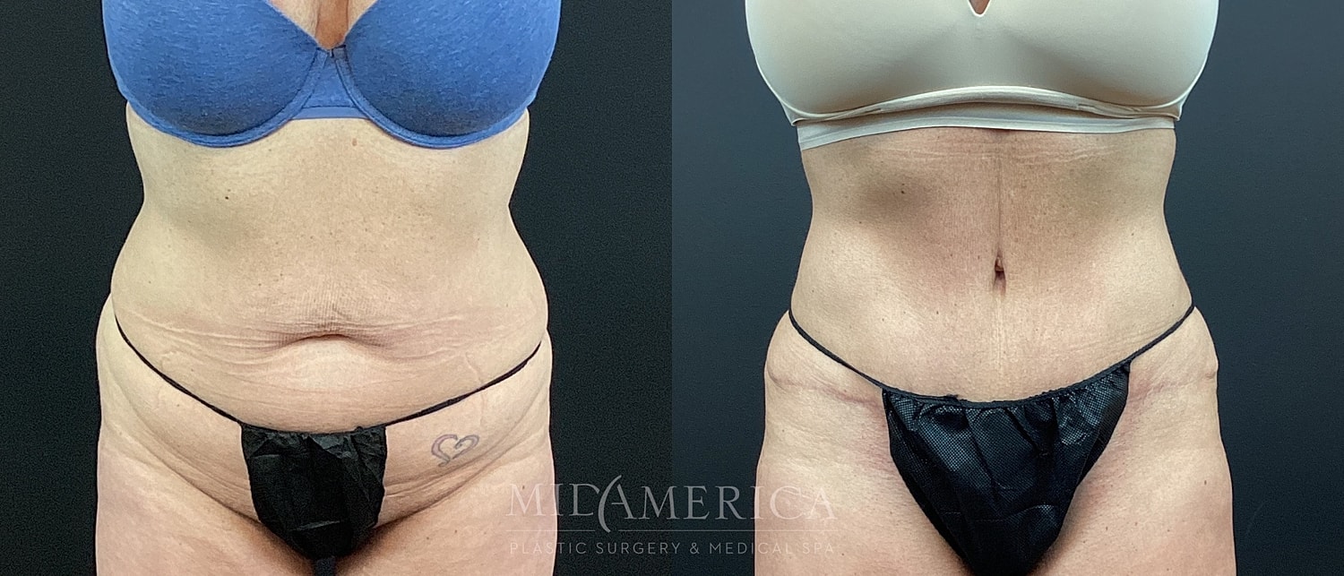 Tummy Tuck Before & After