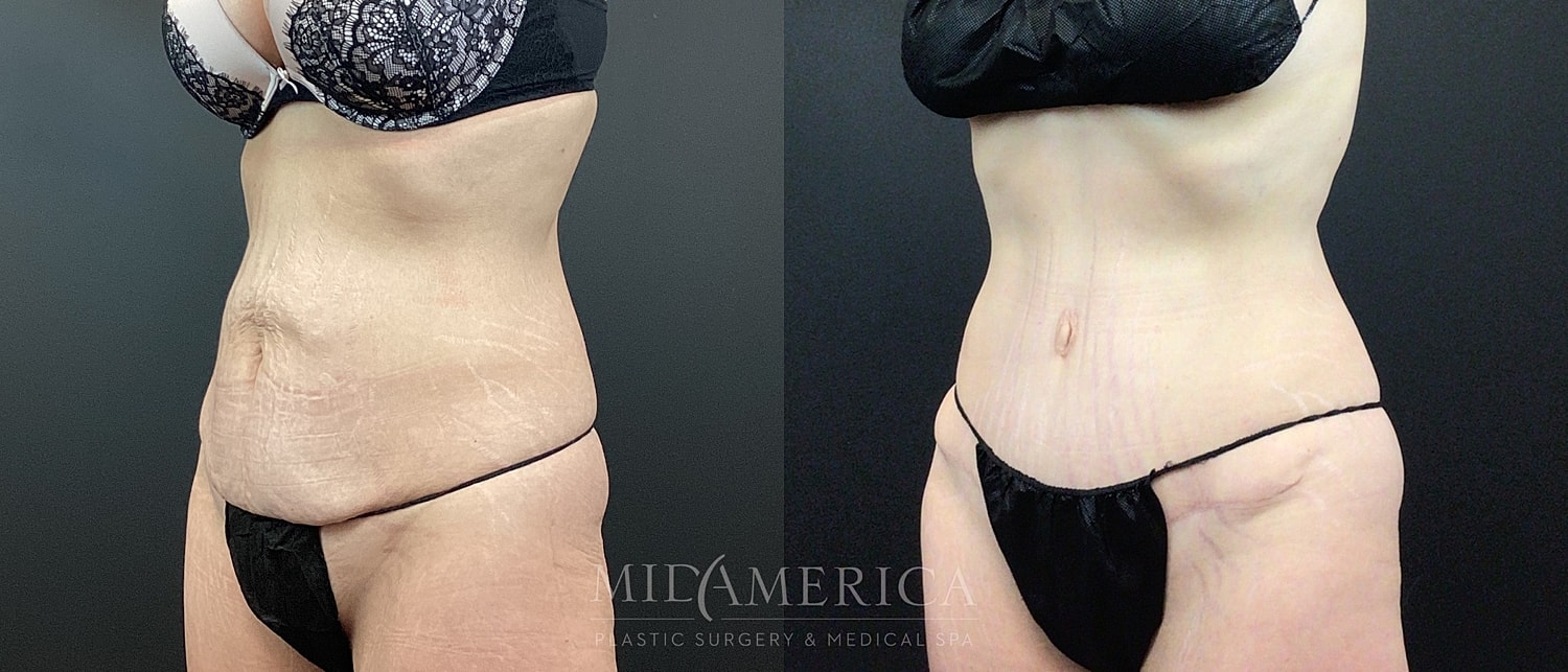 Tummy Tuck Before & After