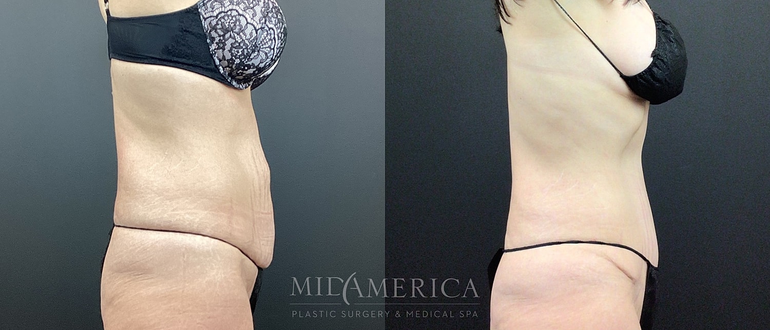 Tummy Tuck Before & After