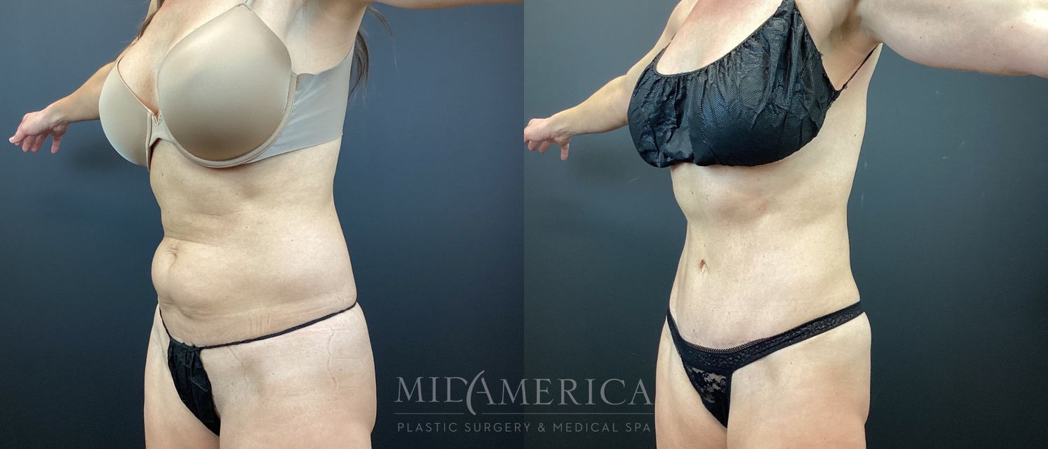 Tummy Tuck Before & After