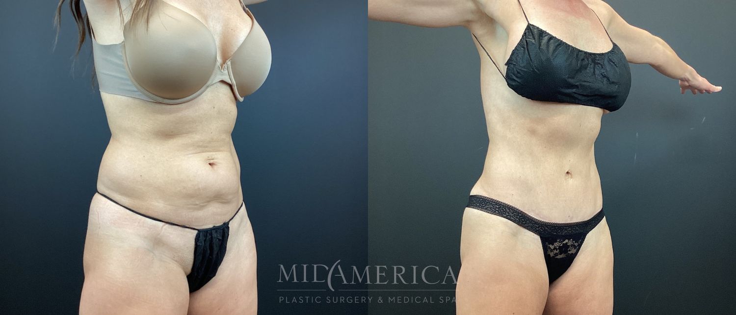 Tummy Tuck Before & After