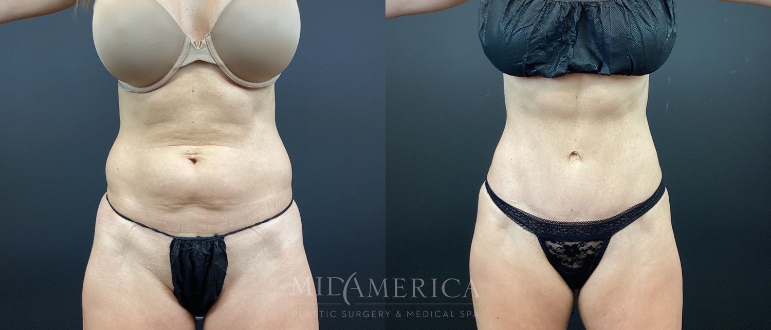 Tummy Tuck Before & After