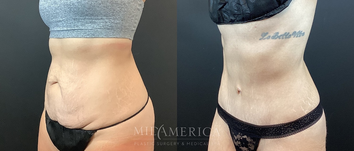 Before and after body contouring surgery results.
