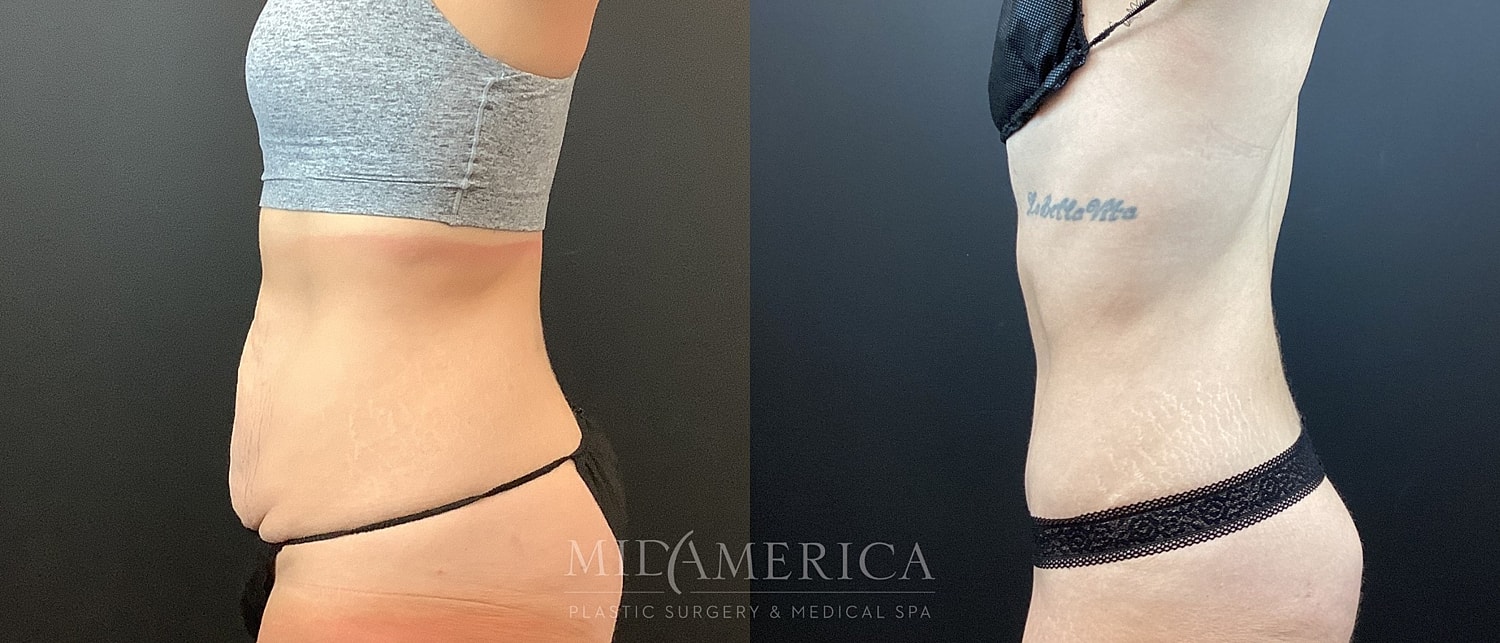 Before and after body transformation comparison photo.