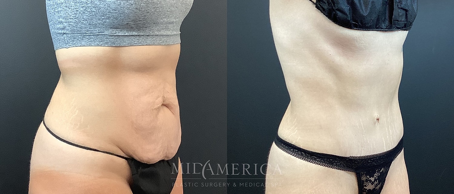 Before and after body transformation comparison photo.