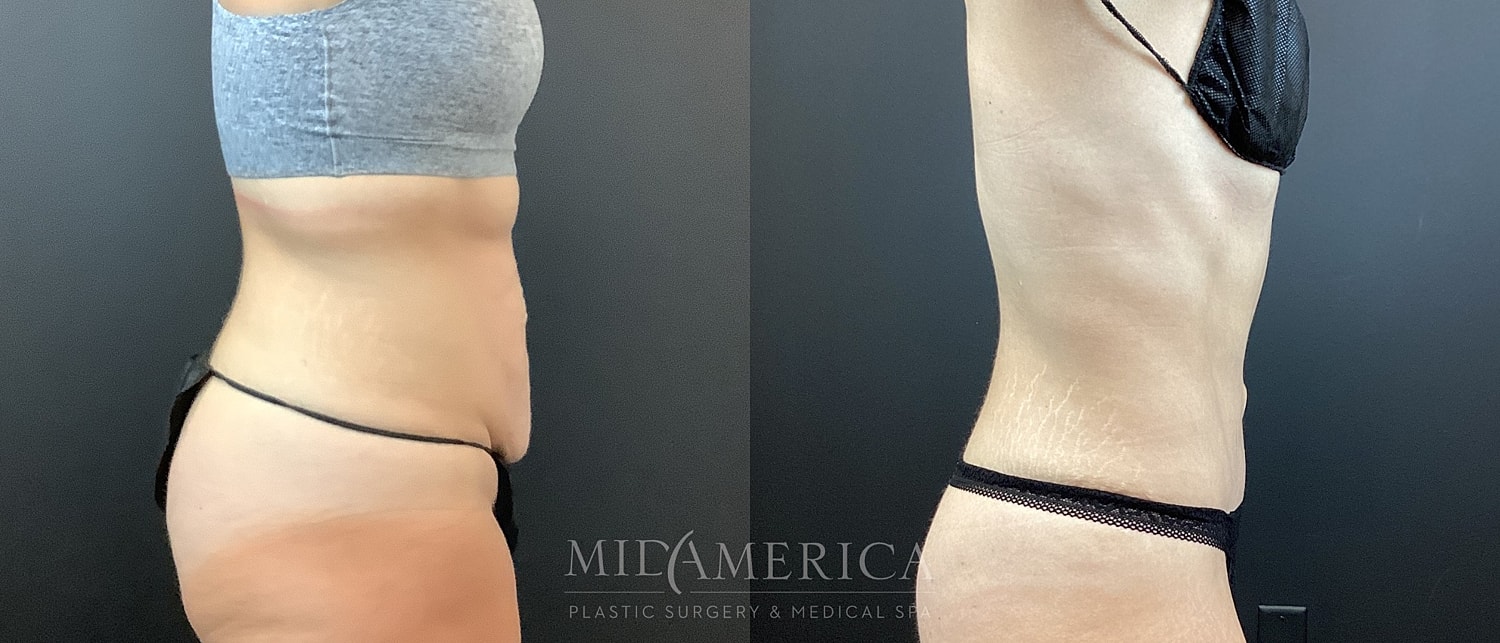Before and after body transformation comparison.