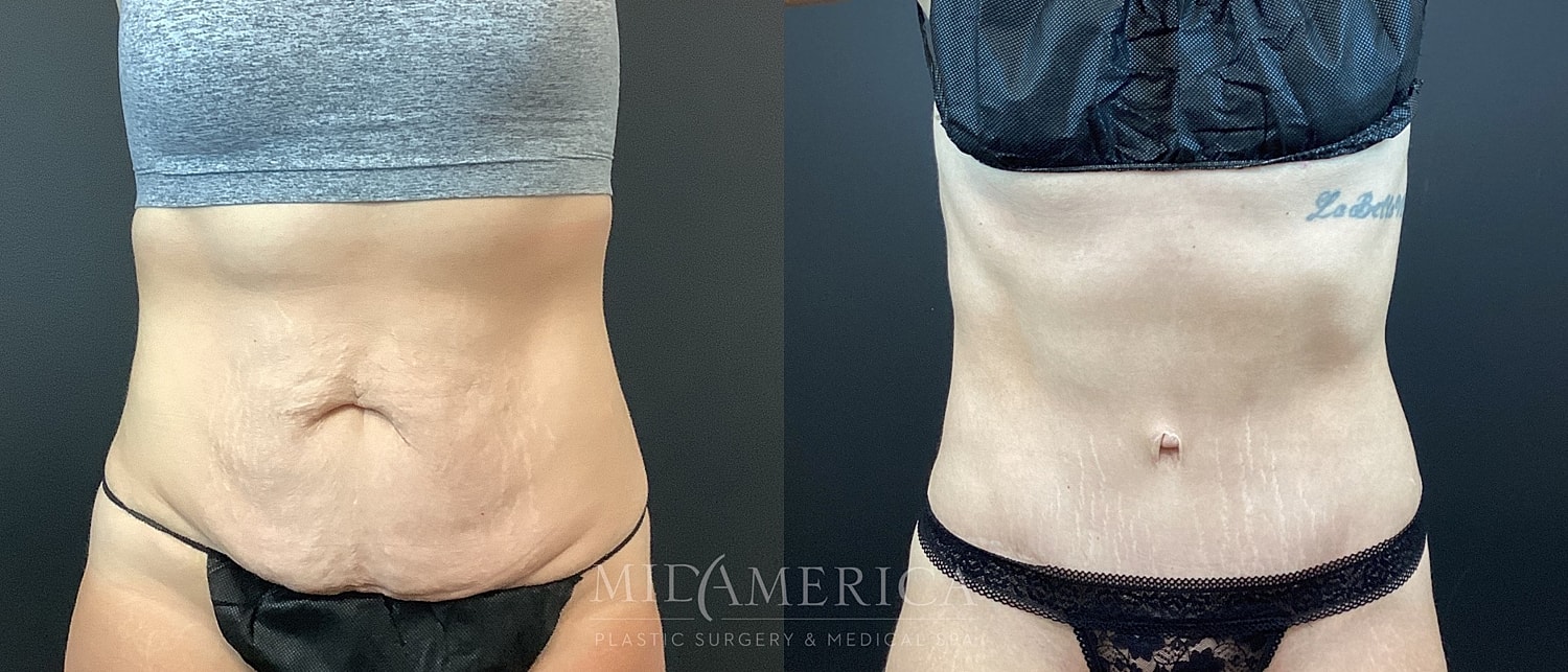 Before and after body transformation photo.