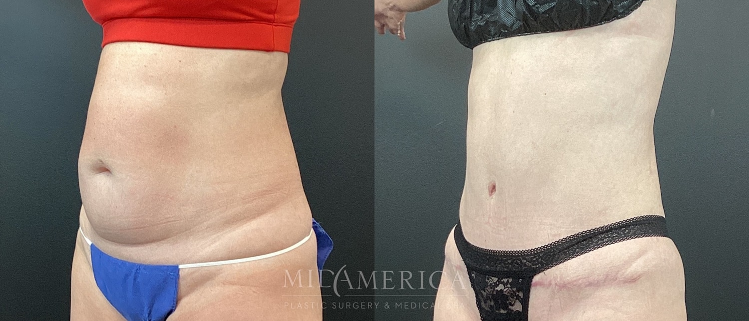 Tummy Tuck Before & After