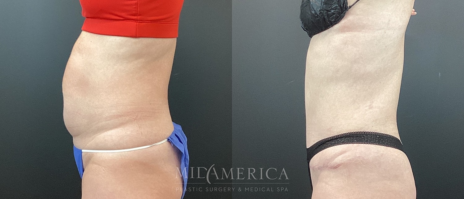 Tummy Tuck Before & After