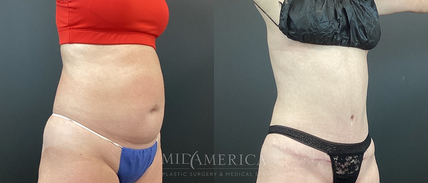 Tummy Tuck Before & After